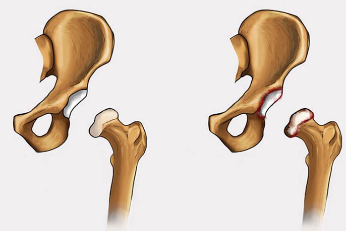 degenerative Veränderungen und Schmerzen im Hüftgelenk
