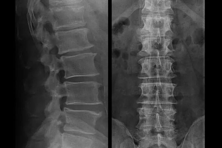 Osteochondrose im Röntgenbild