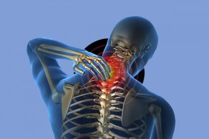Schmerzen im Nacken mit Osteochondrose